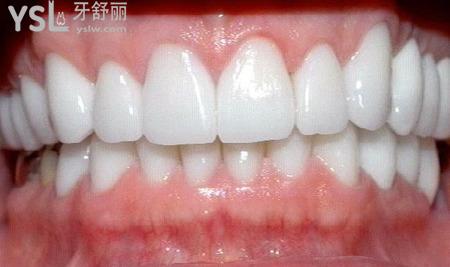 牙龈有脓包可以洗牙吗？