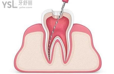 牙神经疼的好的怎么办？