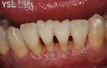 冲牙器对牙齿好不好?听说会导致牙龈萎缩是吗？