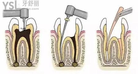 牙齿打桩要多少钱？