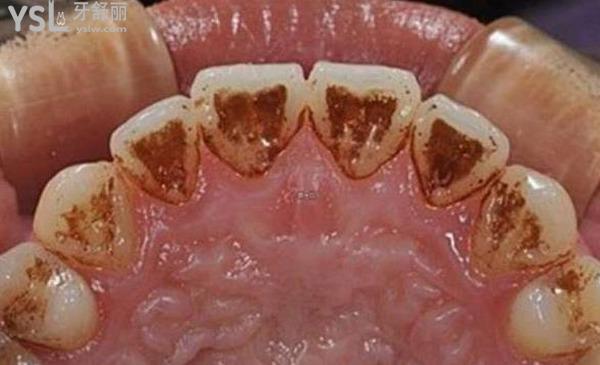 烟垢牙垢是怎么去除的？