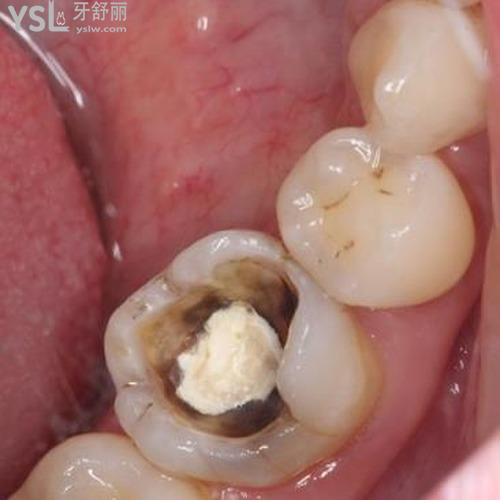 牙齿吃东西会酸痛是怎么回事？