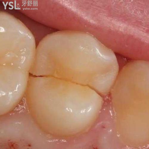 牙齿隐裂怎么治疗？