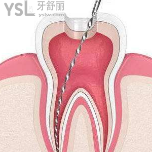 做根管治疗要去几次牙科医院？