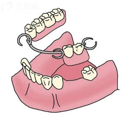 婆婆假牙长期溃疡险些“磨”出口腔癌!所以假牙不合适要调整重做哦