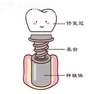 上海牙科种牙价格表公开!/治疗/种植牙费用及医生名单分享