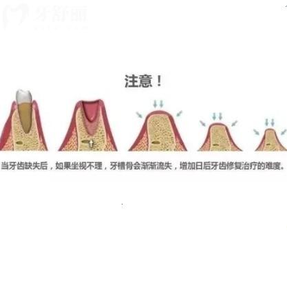 牙槽骨再生手术