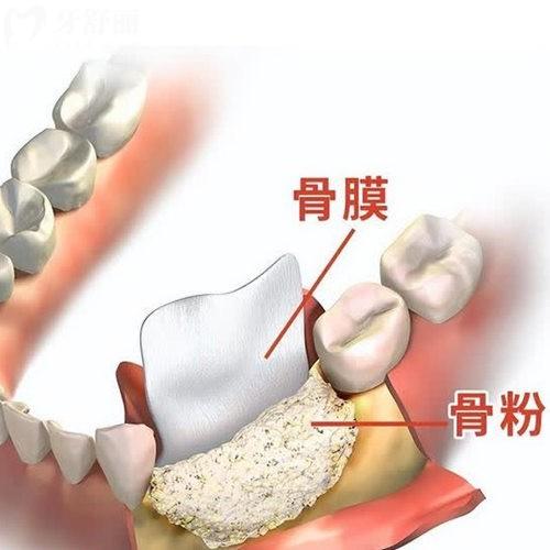 种牙用骨粉骨膜多长时间能消肿?20天还没有消肿正常吗?