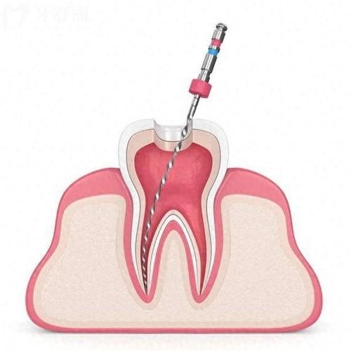 儿童乳牙得深龋有必要做根管治疗吗?有必要,具体的治疗步骤及收费情况请查收