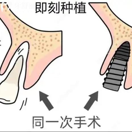 即刻种植牙好还是3月后种植好？两种种牙方式优缺点多方面对比