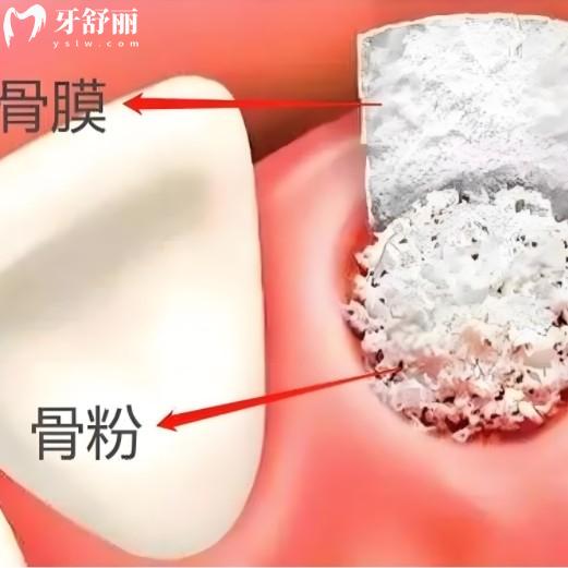 如何自测是否需要植骨粉？自己心里有数种牙不被坑