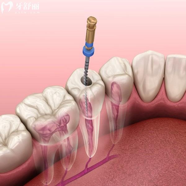 显微镜根管治疗比普通的贵吗?当然,显微镜根管治疗比普通治疗更安心