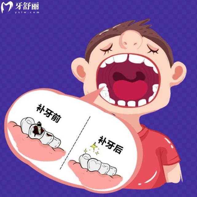 补乳牙用数字还是玻璃离子好？从成分原理优缺点综合对比