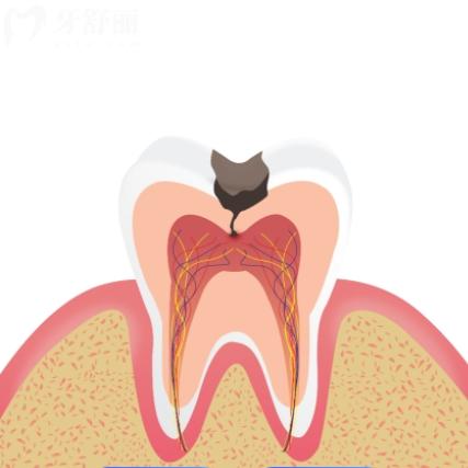 蛀牙不疼但是黑了需要治疗吗？有必要，不要等到入髓后后悔