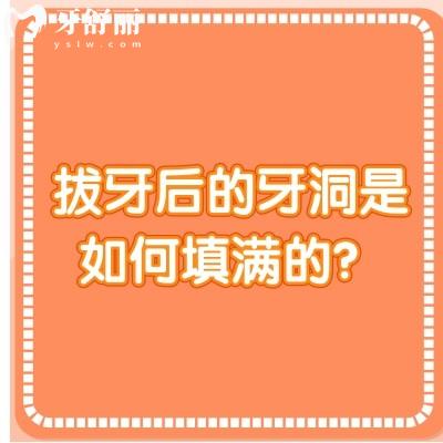 拔牙后的牙洞是如何填满的？一文了解牙洞填满的过程