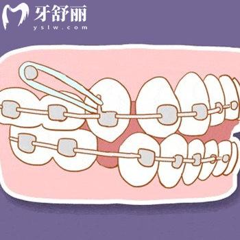 儿童牙齿做牵引的作用大吗?会不会对牙根不好?家长朋友们快来看看吧