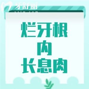 烂牙根里长息肉怎么治疗？这种情况应及时处理医生会给出适合的方案哦