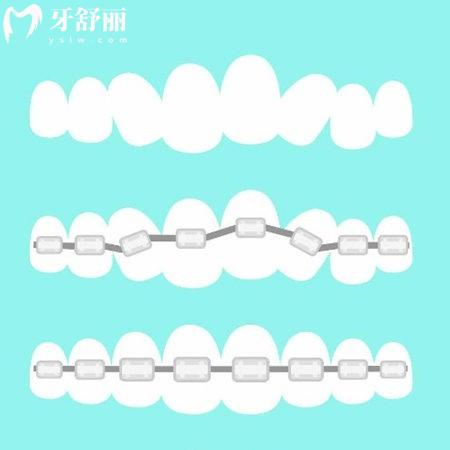 上海牙科正畸医院排名一定要看:矫正好的鼎植/雅悦/拜博口腔矫正实力价格解析